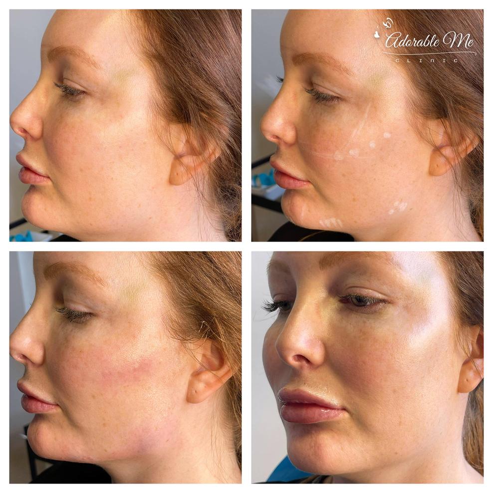 Fillers kindben och käklinje