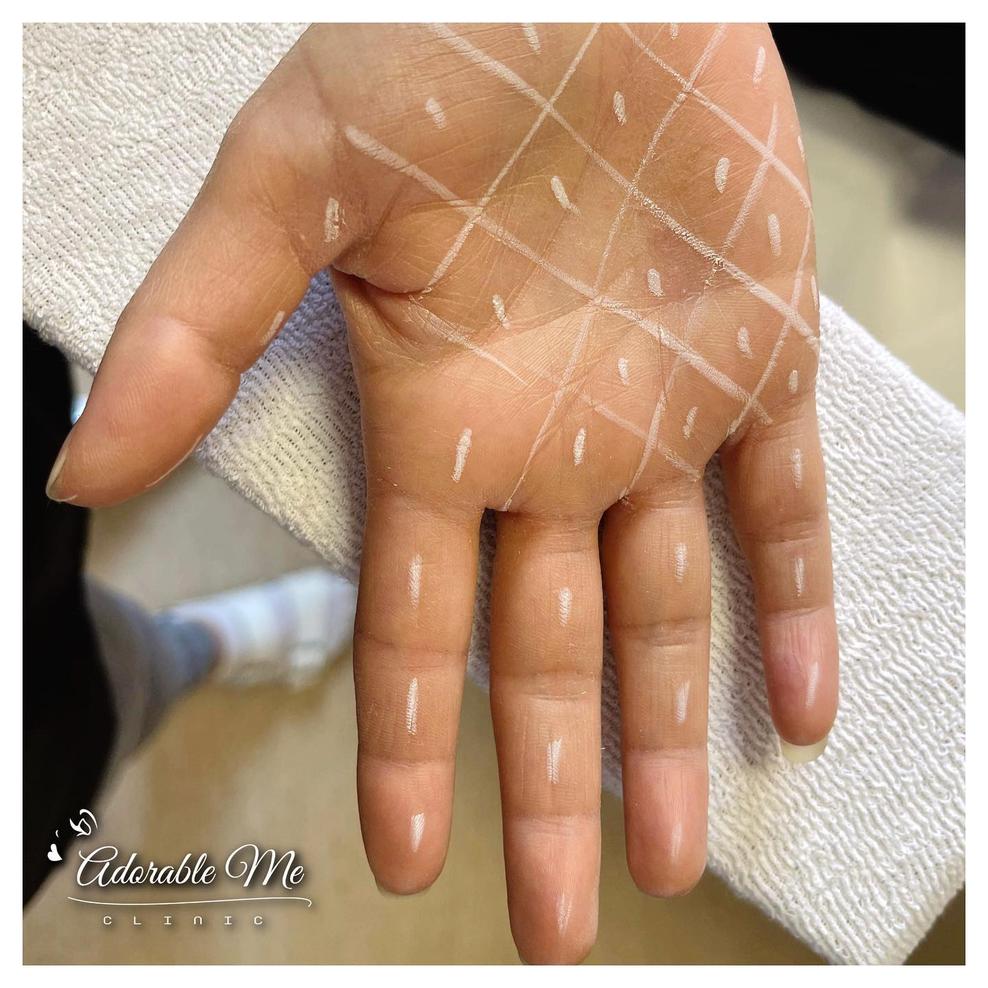 Botox svettbehandling