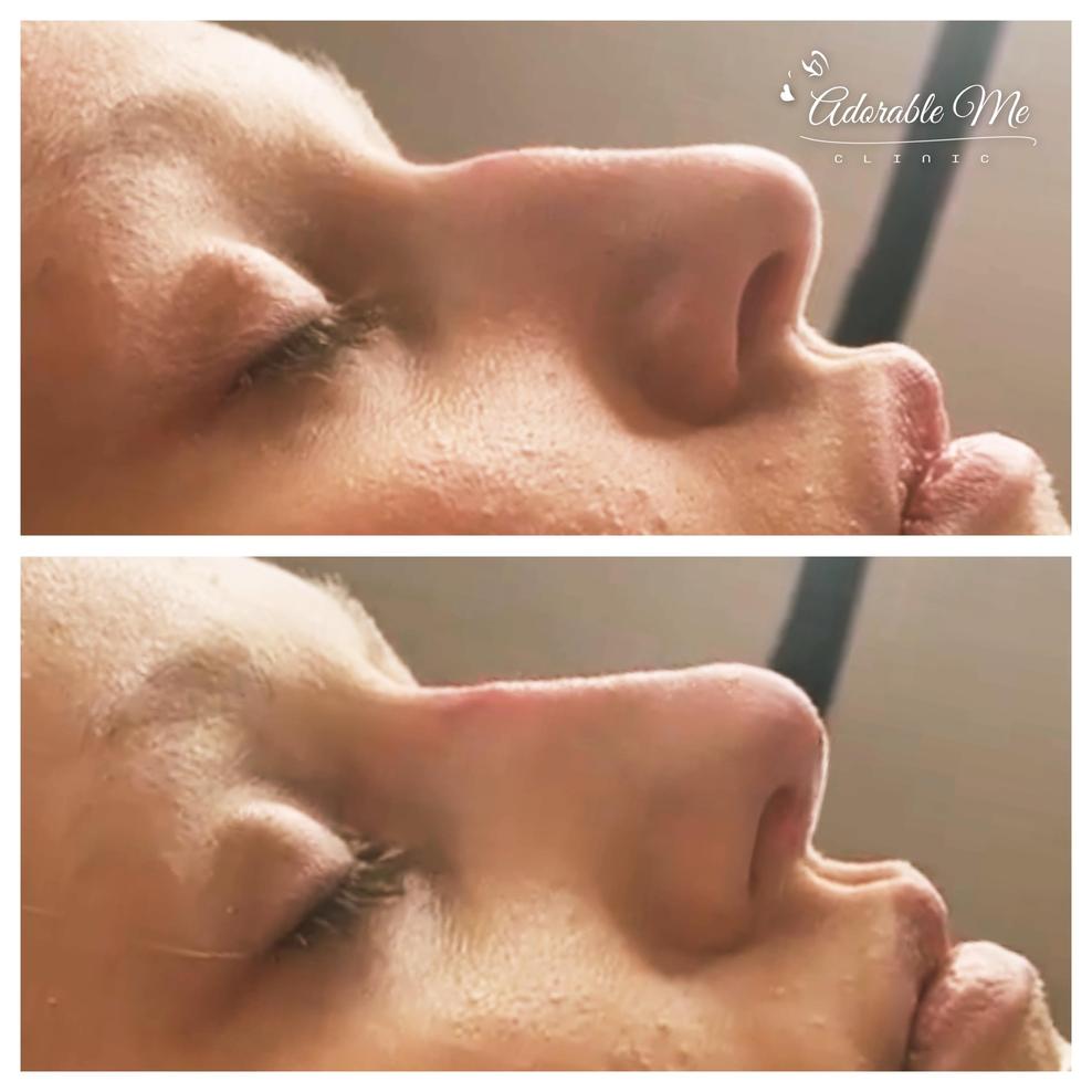 Fillers näskorrigering